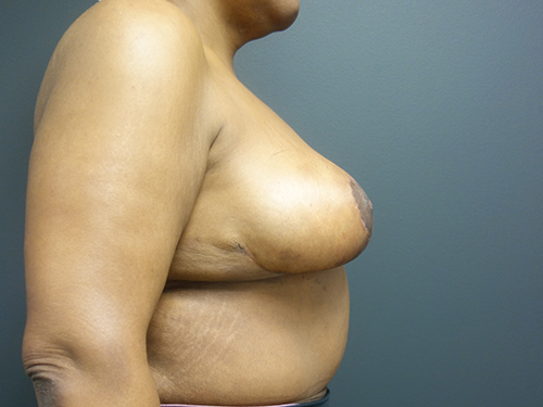 Breast Lift After - Chicago, IL