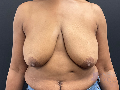Breast Lift Before Breast Lift Before - Chicago, IL