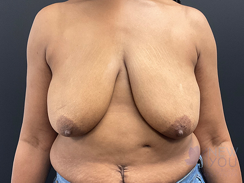 Breast Lift Before - Chicago, IL