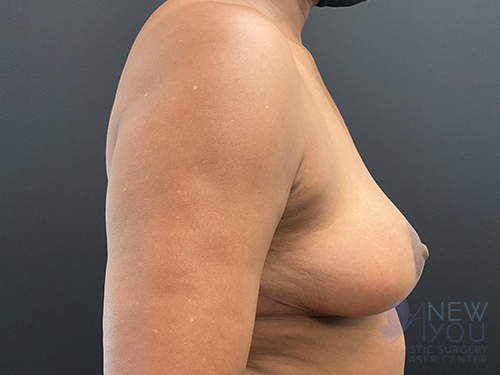 Breast Lift After - Chicago, IL