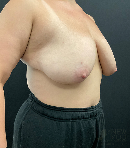 Breast Lift Before - Chicago, IL