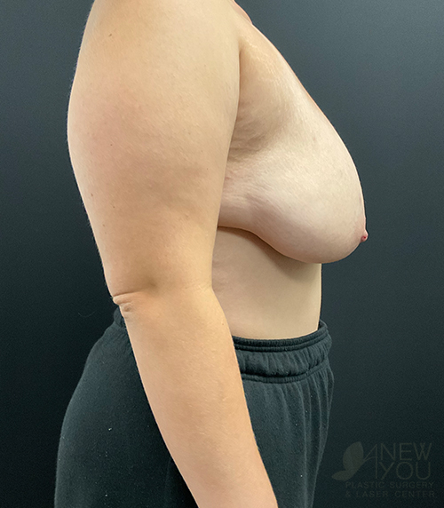 Breast Lift Before - Chicago, IL