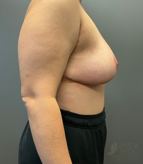 Breast Lift After - Chicago, IL