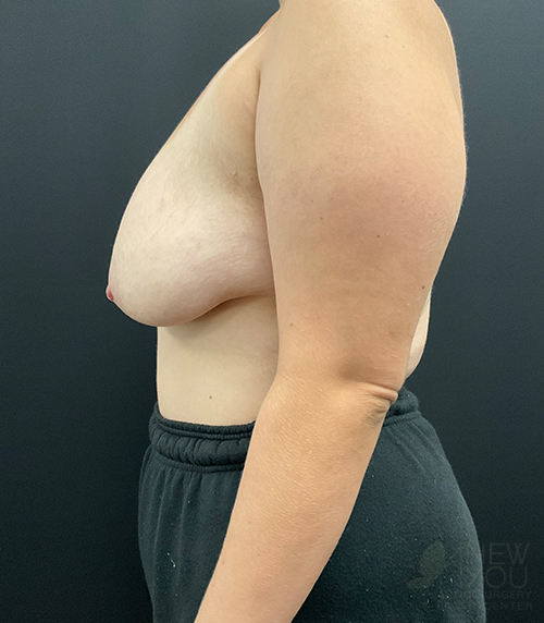 Breast Lift Before - Chicago, IL