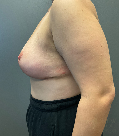 Breast Lift After - Chicago, IL