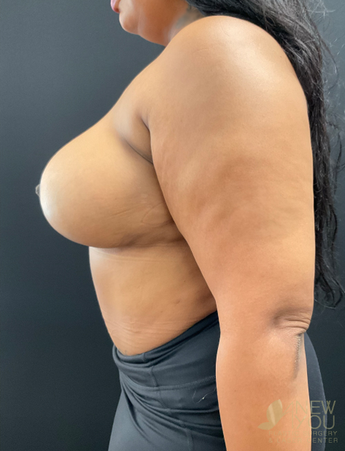 Breast Lift After Breast Lift After - Chicago, IL