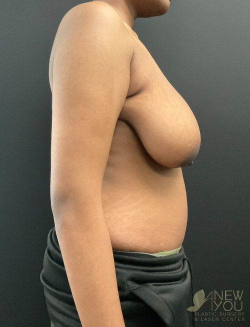 Breast Lift Before Breast Lift Before - Chicago, IL