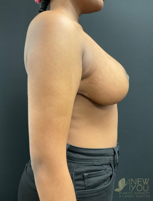 Breast Lift After Breast Lift After - Chicago, IL