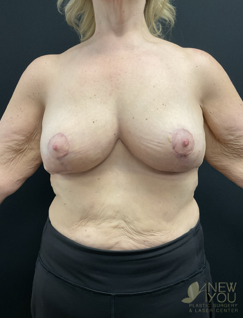 Breast Lift After Breast Lift After - Chicago, IL