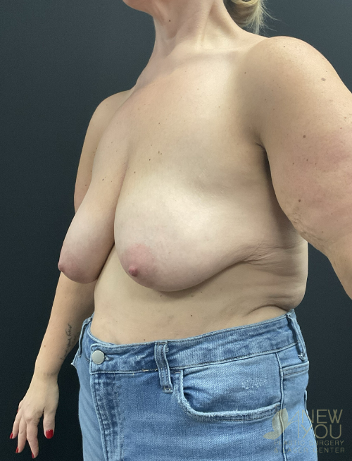 Breast Lift Before Breast Lift Before - Chicago, IL