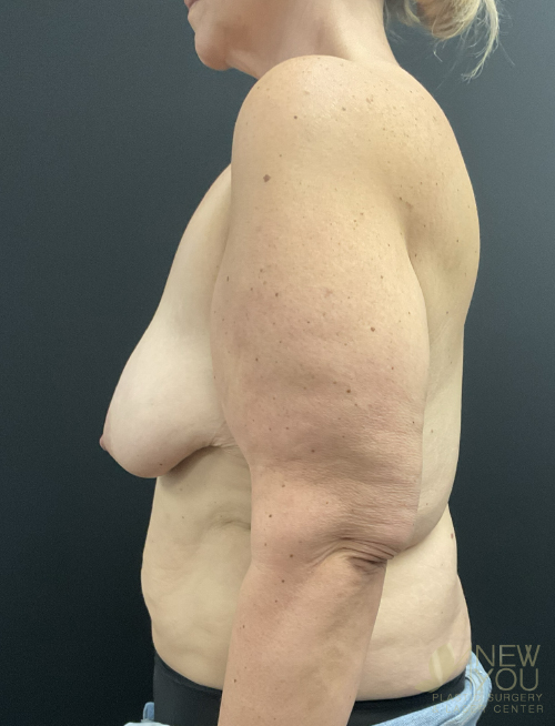 Breast Lift Before Breast Lift Before - Chicago, IL