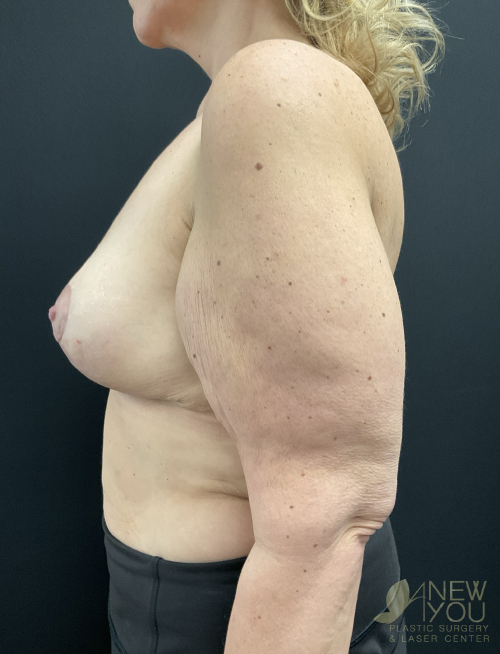 Breast Lift After Breast Lift After - Chicago, IL