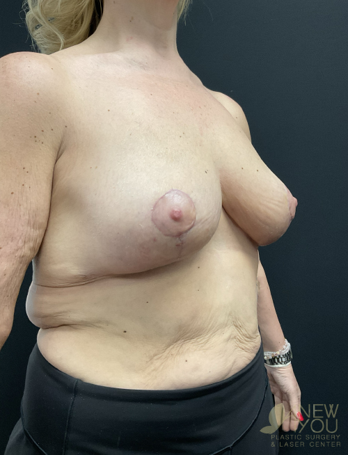 Breast Lift After Breast Lift After - Chicago, IL