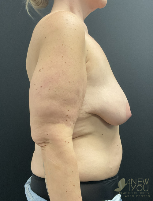 Breast Lift Before Breast Lift Before - Chicago, IL