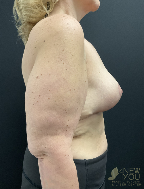 Breast Lift After Breast Lift After - Chicago, IL