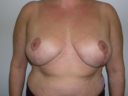 Breast Reduction After - Chicago, IL
