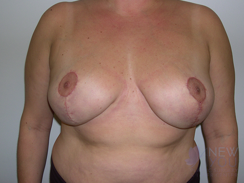 Breast Reduction After Breast Reduction After - Chicago, IL