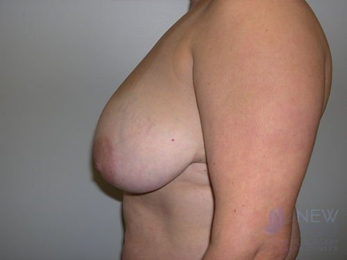 Breast Reduction Before - Chicago, IL