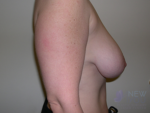 Breast Reduction Before - Chicago, IL