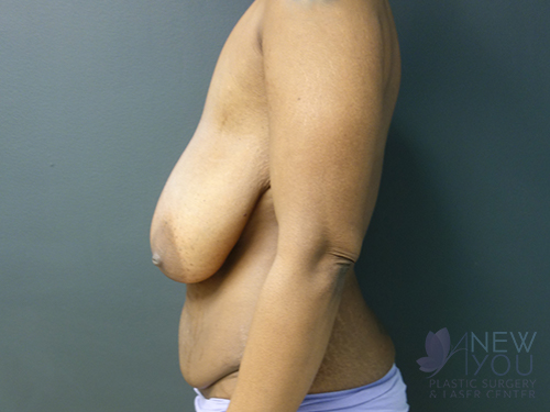 Breast Reduction Before - Chicago, IL