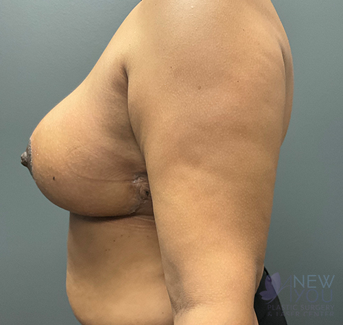 Breast Reduction After - Chicago, IL