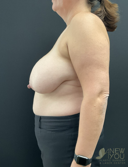Breast Reduction Before Breast Reduction Before - Chicago, IL