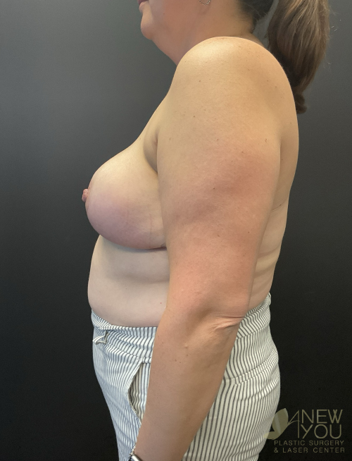 Breast Reduction After Breast Reduction After - Chicago, IL