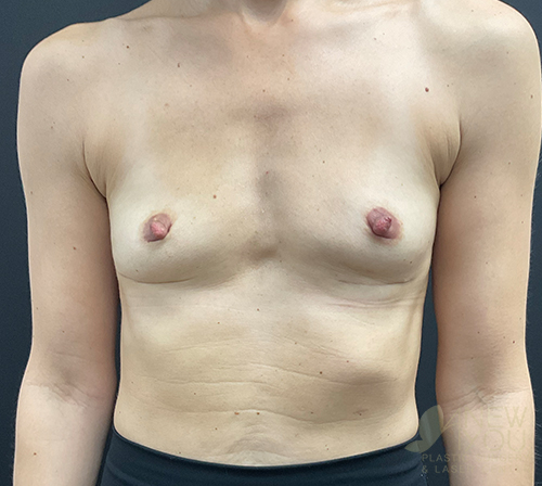 Breast Revision Before - Chicago, IL