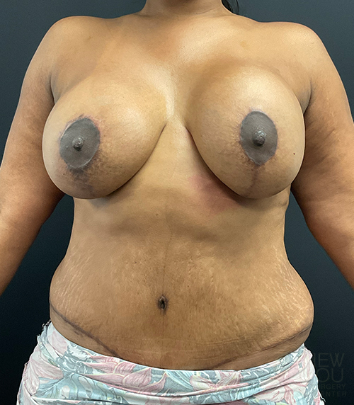 Breast Revision Before - Chicago, IL