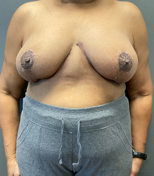 Breast Revision After - Chicago, IL