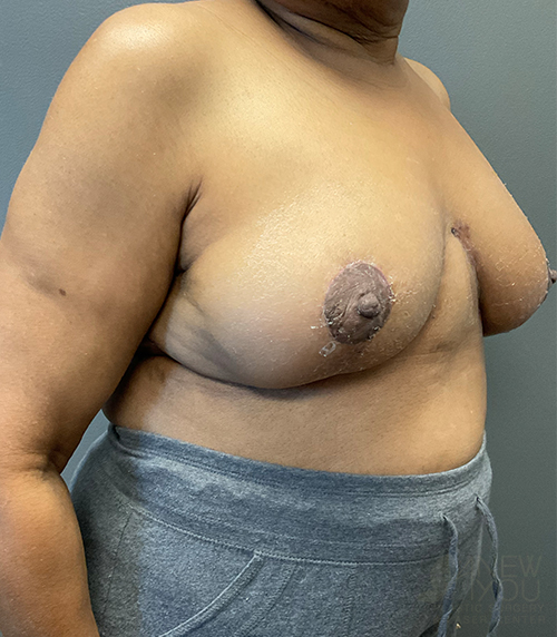 Breast Revision After - Chicago, IL