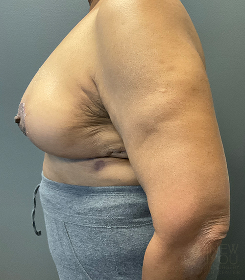 Breast Revision After - Chicago, IL