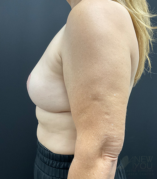 Breast Revision Before Breast Revision Before - Chicago, IL
