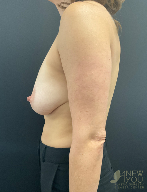 Breast Revision Before Breast Revision Before - Chicago, IL