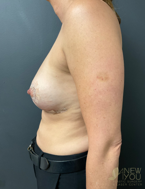 Breast Revision After Breast Revision After - Chicago, IL