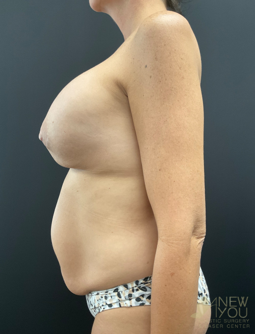Breast Revision Before Breast Revision Before - Chicago, IL
