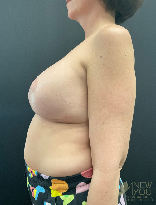Breast Revision After Breast Revision After - Chicago, IL
