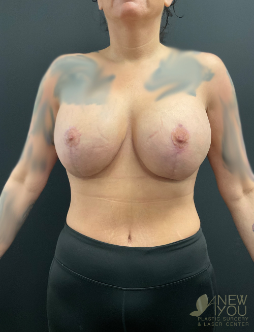 Breast Revision After Breast Revision After - Chicago, IL