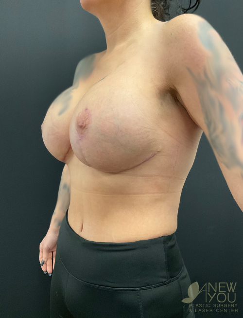 Breast Revision After Breast Revision After - Chicago, IL