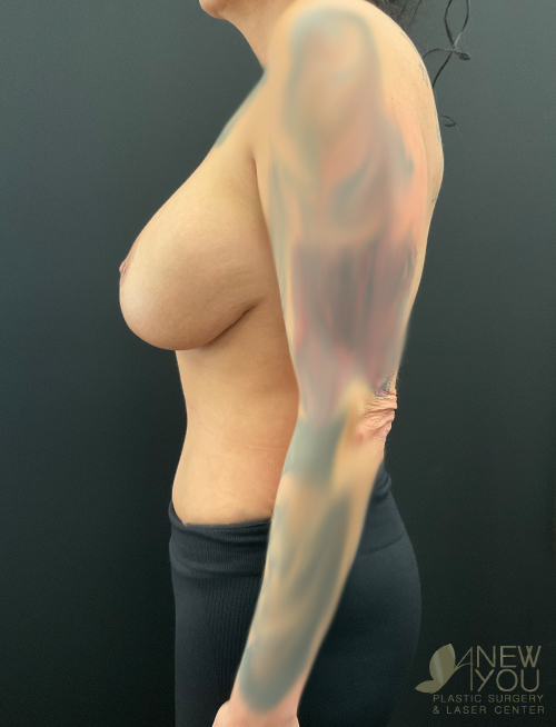 Breast Revision Before Breast Revision Before - Chicago, IL