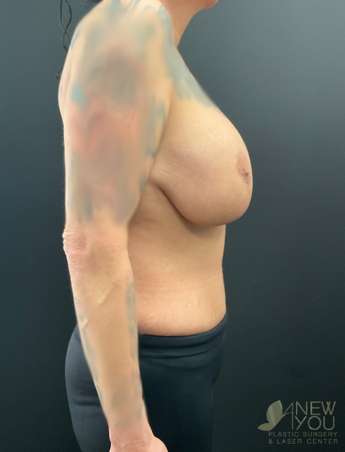 Breast Revision Before Breast Revision Before - Chicago, IL