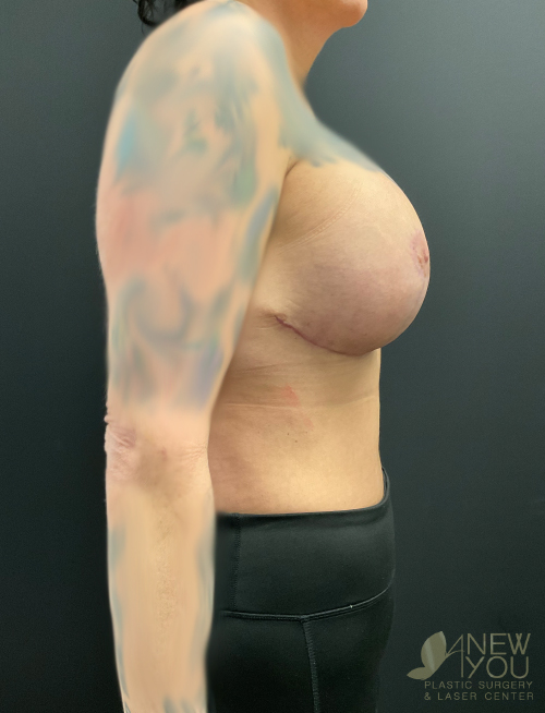 Breast Revision After Breast Revision After - Chicago, IL