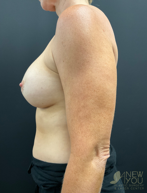 Breast Revision Before Breast Revision Before - Chicago, IL