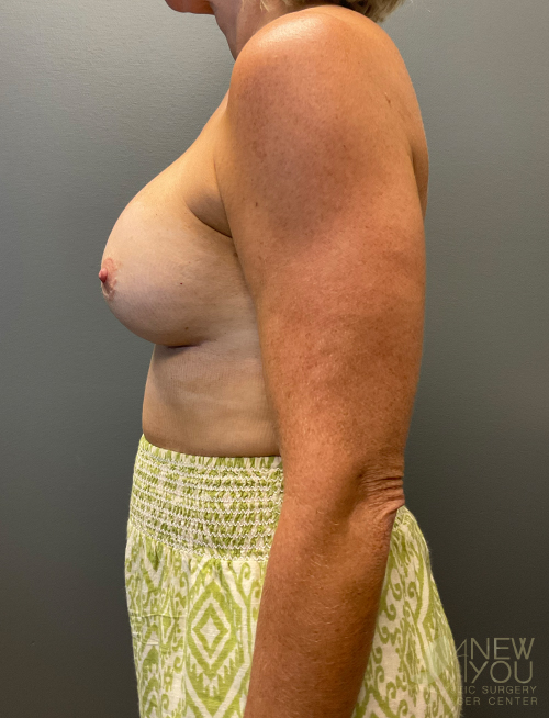 Breast Revision After Breast Revision After - Chicago, IL