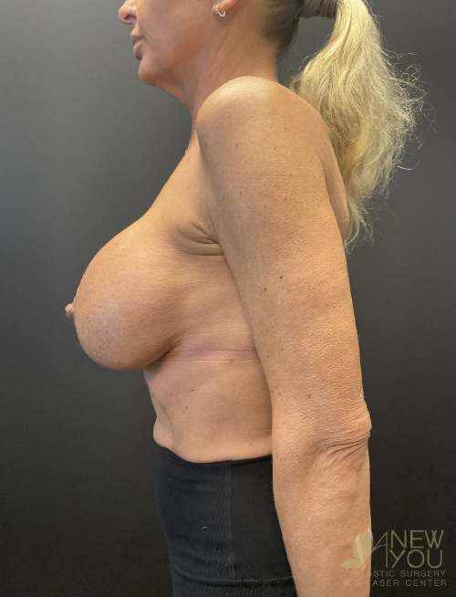 Breast Revision Before - Chicago, IL