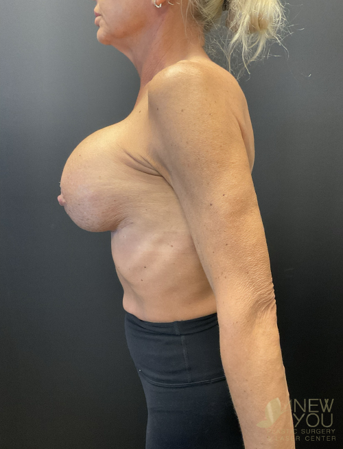 Breast Revision After - Chicago, IL