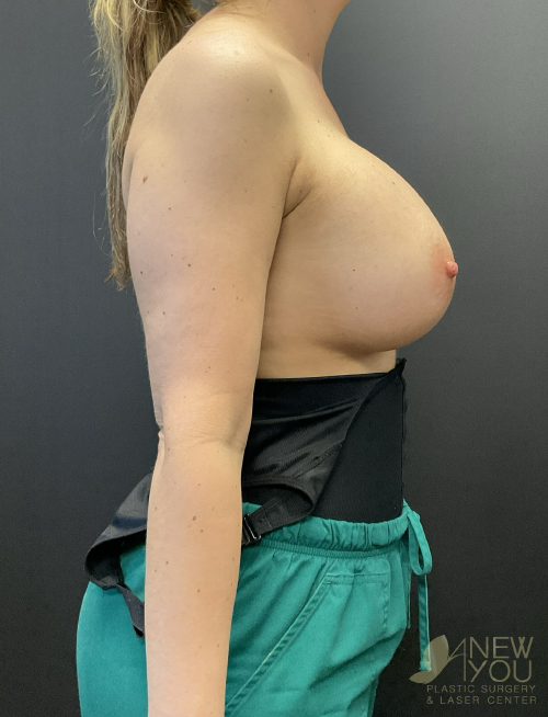 Breast Revision After Breast Revision After - Chicago, IL