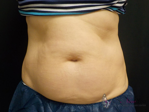 CoolSculpting® Before - Chicago, IL