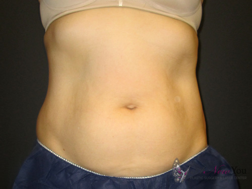 CoolSculpting® After - Chicago, IL