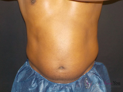 CoolSculpting® Before - Chicago, IL